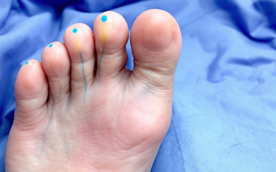Douleur sur le côté extérieur du pied nerf sural : Diagnostic et traitements possibles