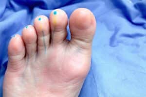 Douleur sur le côté extérieur du pied nerf sural : Diagnostic et traitements possibles